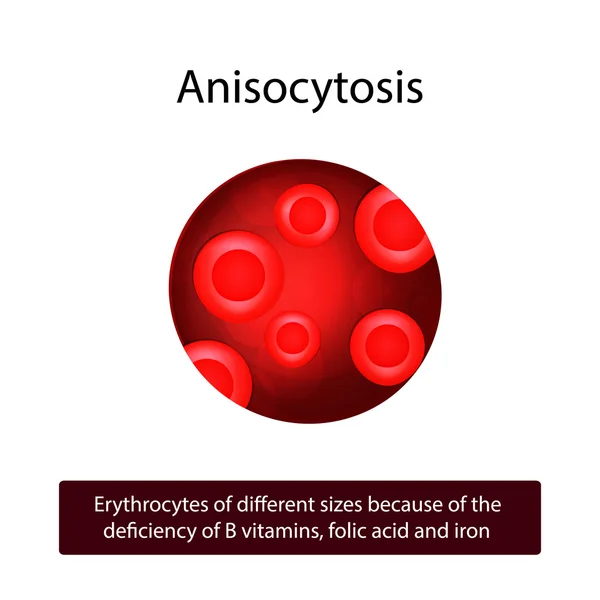 Anisocitosis. Glóbulos rojos de diferentes tamaños debido a la deficiencia de vitaminas del grupo B, ácido fólico y hierro . — Vector de stock