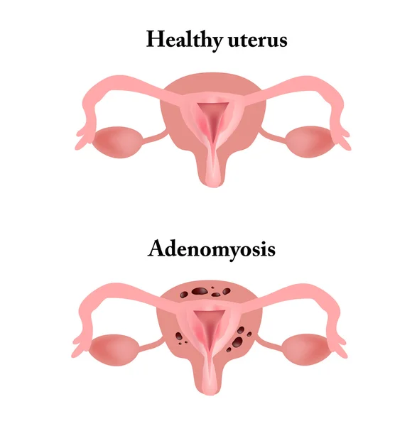 Endometrióza. Struktura pánevních orgánů. Adenomyosis. Endometrium. Vektorové ilustrace — Stockový vektor