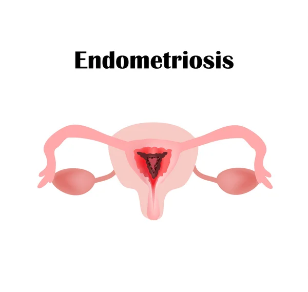 Endometrióza. Struktura pánevních orgánů. Adenomyosis. Endometrium. Vektorové ilustrace — Stockový vektor