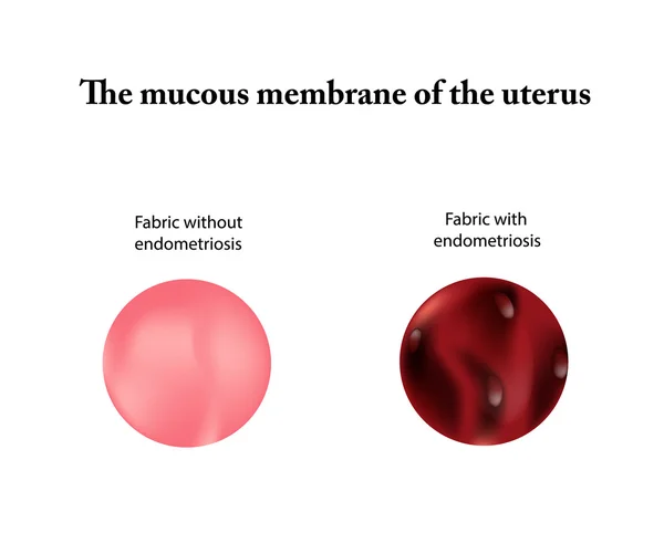 Endometriose. Adenomiose. O endométrio. Ilustração vetorial sobre fundo isolado —  Vetores de Stock