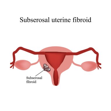 Subserous uterin fibroids. Endometriozis. Infographics. Vektör illüstrasyon izole arka plan üzerinde