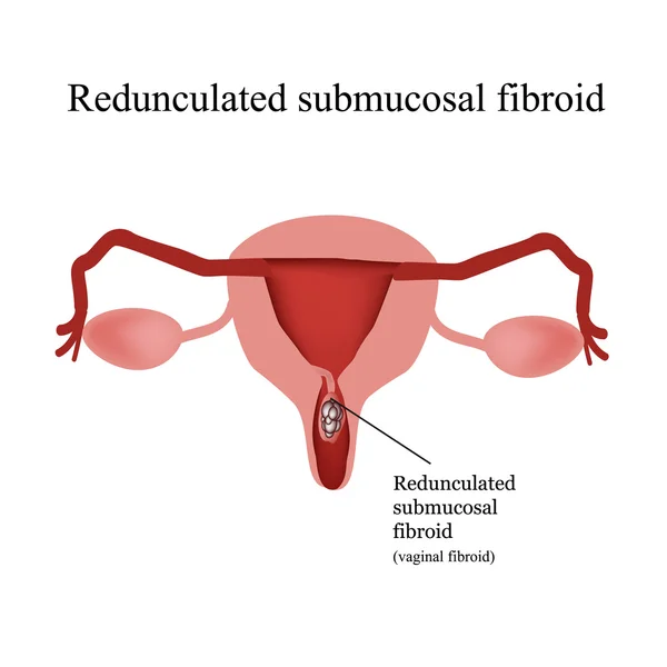 Fibromas uterinos submucosos pedunculados. Fibromas vaginales. Infografías. Ilustración vectorial sobre fondo aislado — Vector de stock