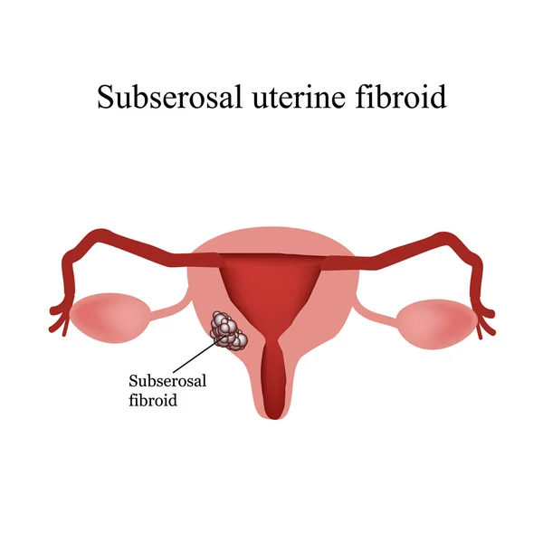 Subserous děložní myomy. Endometrióza. Infografiky. Vektorové ilustrace na izolované pozadí — Stockový vektor