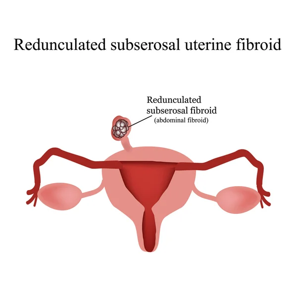 Miomas uterinos subserosos pedunculados. Infográficos. Ilustração vetorial sobre fundo isolado — Vetor de Stock