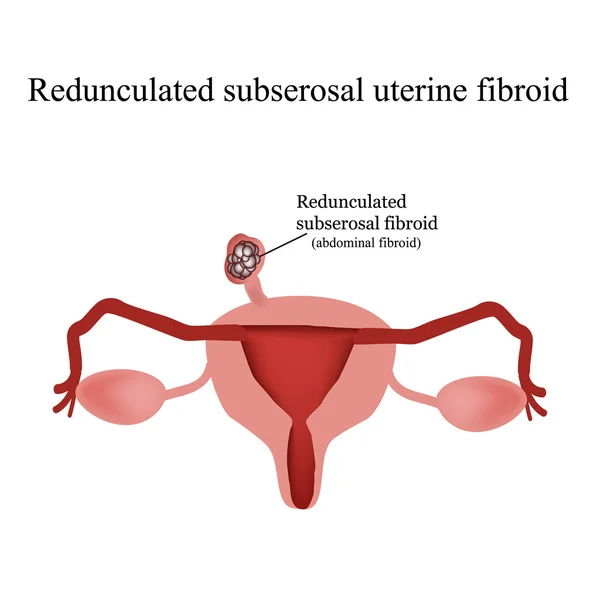 Miomas uterinos subserosos pedunculados. Infográficos. Ilustração vetorial sobre fundo isolado —  Vetores de Stock