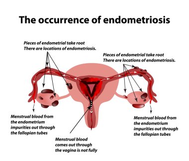 Endometriozis. Hastalık endometriozis görünümü. Endometrium. Infographics. Vektör çizim
