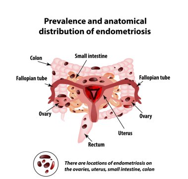 Endometriozis. Hastalık endometriozis görünümü. Endometrium. İki nokta üst üste. İnce bağırsak. Infographics. Vektör