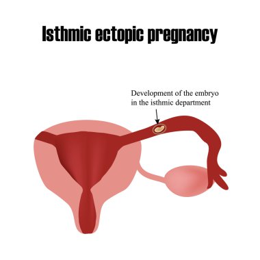 İsthmic departmanında embriyo gelişimi. Dış gebelik. Infographics. Vektör illüstrasyon izole arka plan üzerinde
