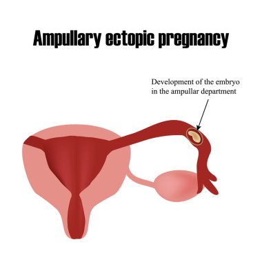 Ampullar departmanında embriyo gelişimi. Dış gebelik. Infographics. Vektör illüstrasyon izole arka plan üzerinde