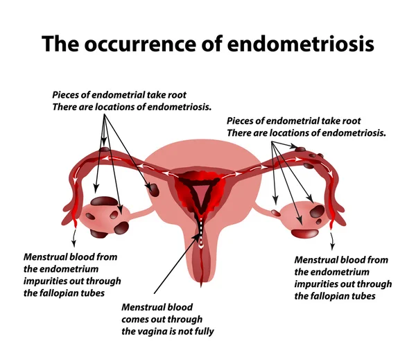 Endometriose. das Auftreten der Endometriose. Endometrium. Infografiken. Vektorillustration — Stockvektor