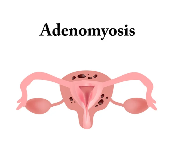 Endometrióza. Struktura pánevních orgánů. Adenomyosis. Endometrium. Vektorové ilustrace — Stockový vektor