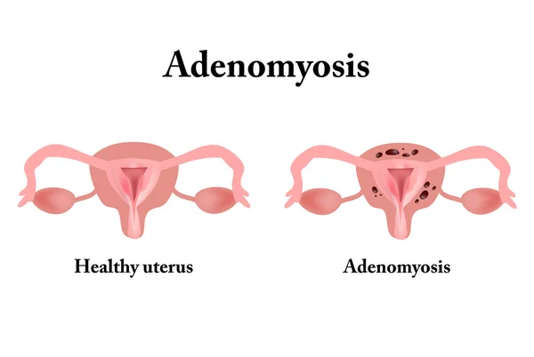 Endometriosis. A kismedencei szervek szerkezete. Adenomyosis. A méhnyálkahártya. Vektoros illusztráció — Stock Vector