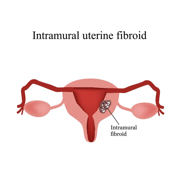 Miomas uterinos intramuros. Endometriose. Infográficos. Ilustração vetorial isolada sobre fundo branco — Vetor de Stock