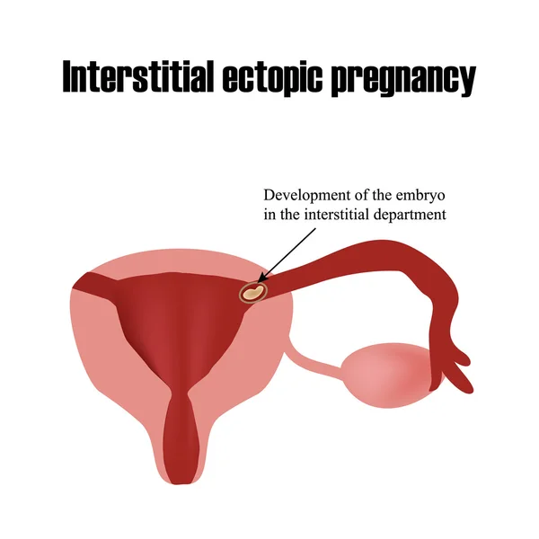 Desarrollo del embrión en el departamento intersticial. Embarazo ectópico. Infografías. Ilustración vectorial — Archivo Imágenes Vectoriales