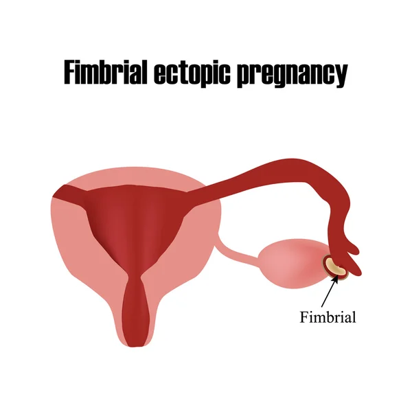 Desarrollo del embrión en el departamento fimbrial. Embarazo ectópico. Infografías. Ilustración vectorial sobre fondo aislado — Vector de stock