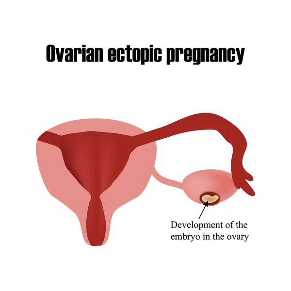 Ontwikkeling van het embryo in de eierstok. Buitenbaarmoederlijke zwangerschap. Infographics. Vectorillustratie op geïsoleerde achtergrond — Stockvector