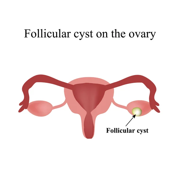 Cisto ovárico folicular. Cisto funcional. Infográficos. Ilustração vetorial sobre fundo isolado —  Vetores de Stock