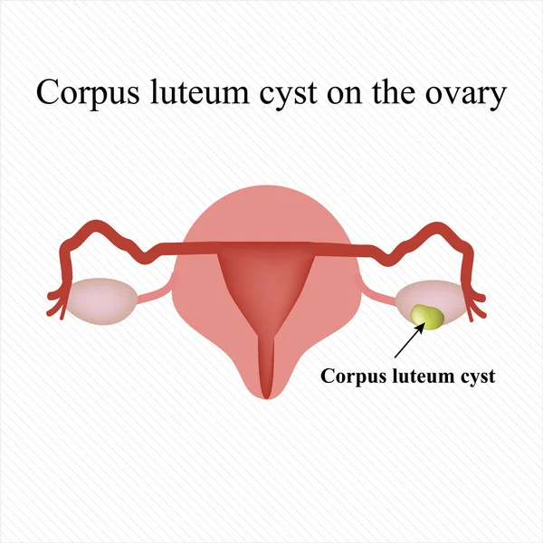 Quiste de cuerpo lúteo en el ovario. Quiste funcional. Ovario. Infografías. Ilustración vectorial — Vector de stock