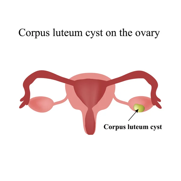 Corpus luteum cyst on the ovary. Functional cyst. Ovary. Infographics. Vector illustration on isolated background — Stock Vector