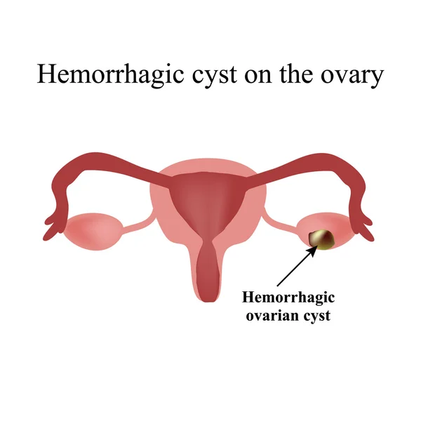 Hemorrhagic cystor på äggstockarna. Äggstock. Infographics. Vektor illustration på isolerade bakgrund — Stock vektor
