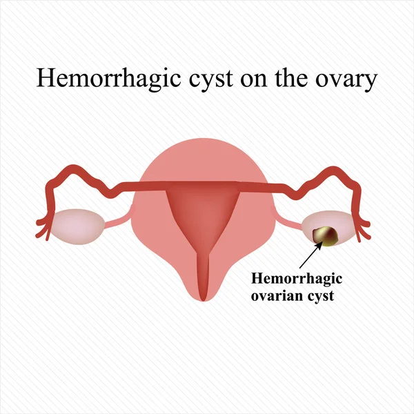 Hemorrhagic cyst on the ovary. Ovary. Infographics. Vector illustration — Stock Vector
