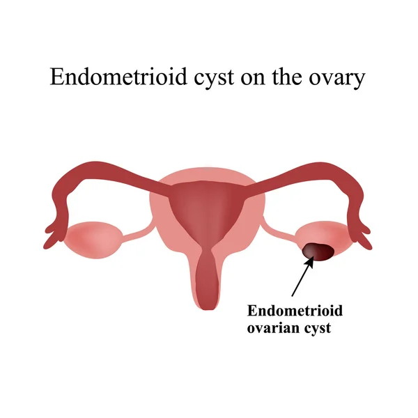 Endometrioid cysta na vaječníku. Endometrióza. Vaječník. Infografiky. Vektorové ilustrace na izolované pozadí — Stockový vektor