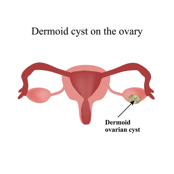 Quiste dermoide en el ovario. Ovario. Infografías. Ilustración vectorial sobre fondo aislado — Vector de stock