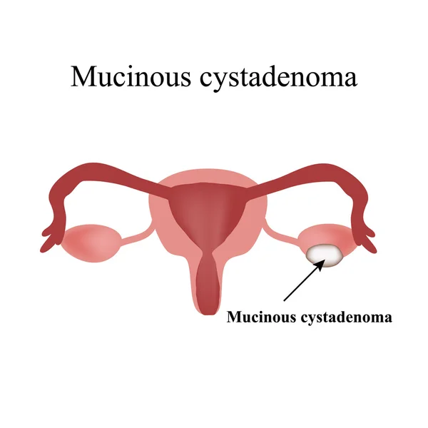 Cisto mucinoso no ovário. Cistadenoma. Ovário. Infográficos. Ilustração vetorial sobre fundo isolado — Vetor de Stock