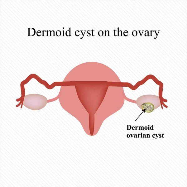 Quiste dermoide en el ovario. Ovario. Infografías. Ilustración vectorial — Vector de stock