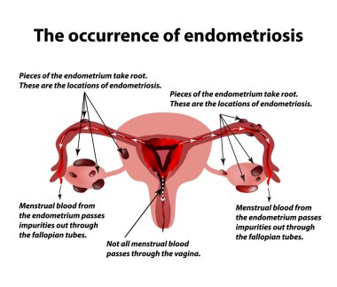 Endometriozis. Hastalık endometriozis görünümü. Endometrium. Infographics. Vektör çizim