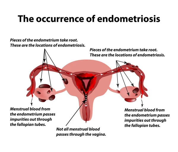 Эндометриоз. Появление эндометриоза заболевания. Эндометриум. Инфографика. Векторная иллюстрация — стоковый вектор