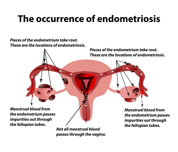 Endometriose. Het uiterlijk van de ziekte endometriose. Baarmoederslijmvlies. Infographics. Vectorillustratie — Stockvector