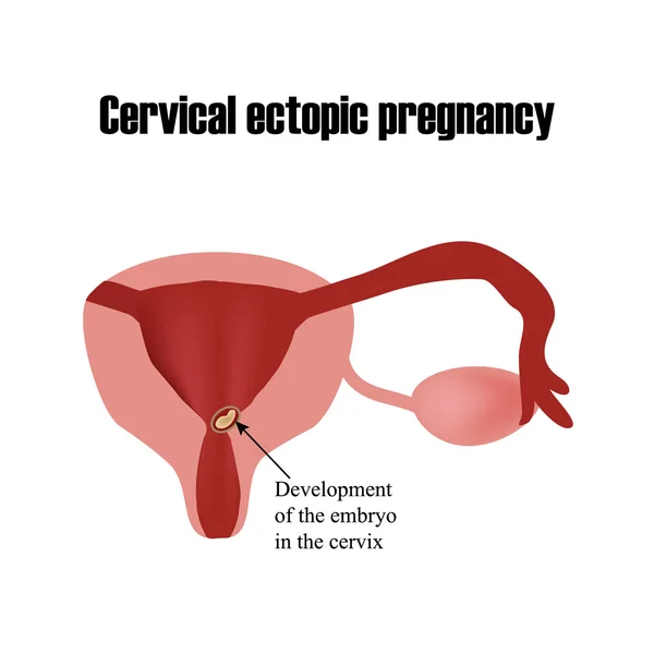 Ontwikkeling van het embryo in de baarmoederhals. Buitenbaarmoederlijke zwangerschap. Infographics. Vectorillustratie op geïsoleerde achtergrond — Stockvector