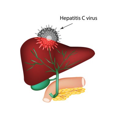 Hepatit C. Hepatit C virüs karaciğerde giriş. Sindirim sisteminin yapısını. Safra kesesi. Pankreas. Safra kanalları. Oniki parmak bağırsağı. Dünya hepatit günü. Vektör çizim