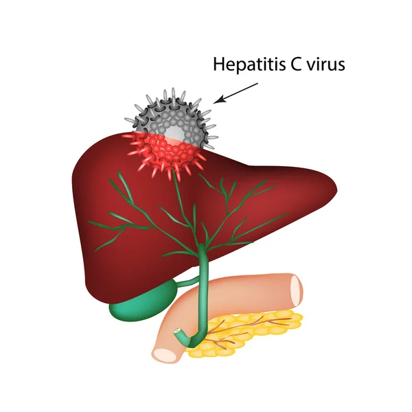 Hepatitis C. Introducción del virus de la hepatitis C en el hígado. La estructura del sistema digestivo. vesícula biliar. Páncreas. Conductos biliares. Duodeno. Día Mundial de la Hepatitis. Ilustración vectorial — Vector de stock