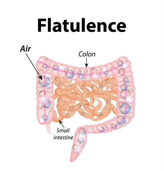 Flatulenza. Gas nell'intestino tenue. I gas nel colon. L'aria nell'intestino. La struttura dell'intestino. Infografica. Illustrazione vettoriale su sfondo isolato — Vettoriale Stock