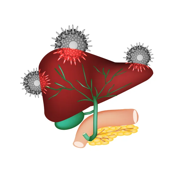 Hepatitis. Introducción del virus de la hepatitis en el hígado. La estructura del sistema digestivo. vesícula biliar. Páncreas. Conductos biliares. Duodeno. Día Mundial de la Hepatitis. Ilustración vectorial — Archivo Imágenes Vectoriales