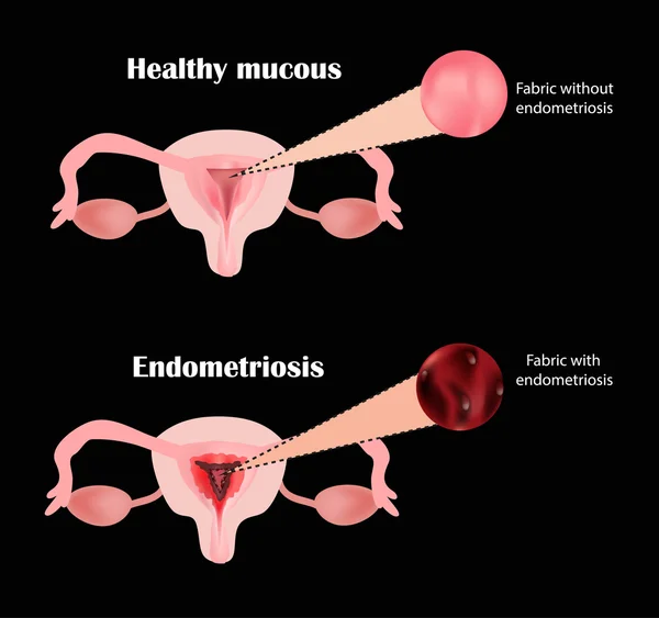 Endometrióza. Struktura pánevních orgánů. Adenomyosis. Endometrium. Vektorové ilustrace — Stockový vektor