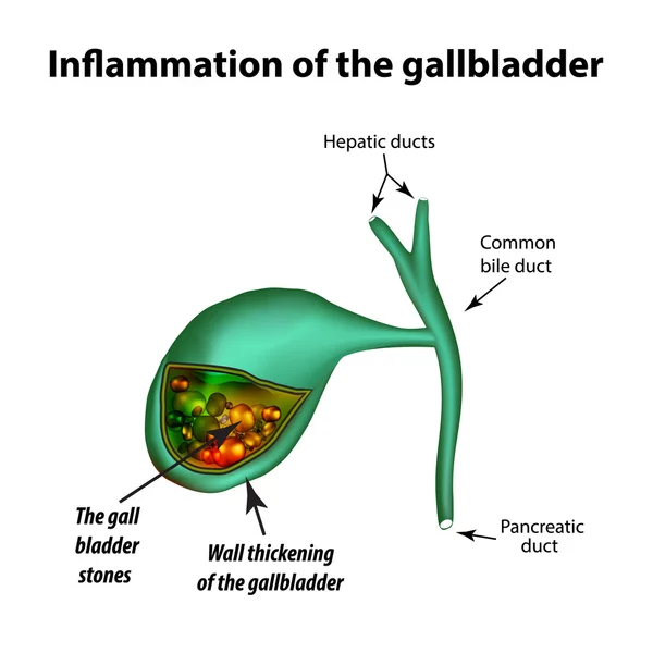 Cálculos biliares. Colelitiasis. Colecistitis. Inflamación de la vesícula biliar. Infografías. Ilustración vectorial sobre fondo aislado — Vector de stock