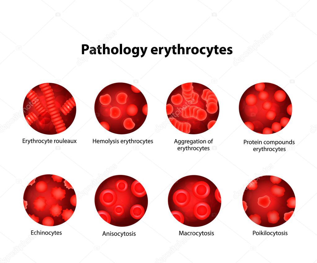 Pathology Of Red Blood Cells Erythrocytes Set Infographics Vector