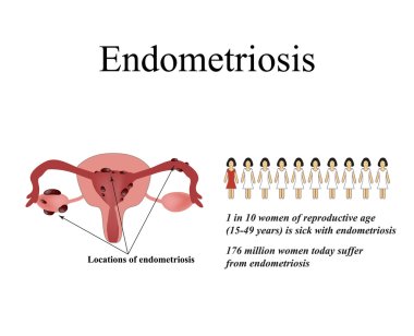 Endometriosis. Endometrial cysts. The endometrium. Statistics endometriosis. The structure of the pelvic organs. Infographics. Vector illustration on isolated background clipart