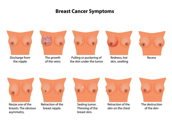 Sintomas de cancro da mama. Infográficos. Ilustração vetorial sobre fundo isolado — Vetor de Stock