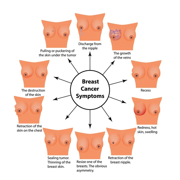 Síntomas de cáncer de mama. Infografías. Ilustración vectorial sobre fondo aislado — Vector de stock