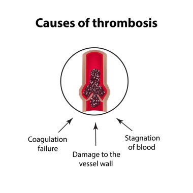 Causes of thrombocytosis. Embolism. Infographics. Vector illustration on isolated background clipart