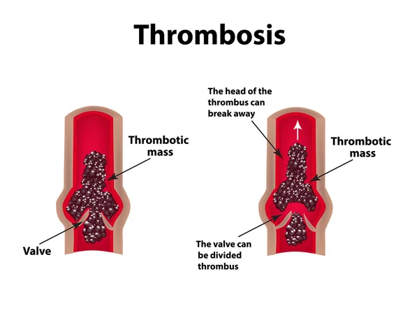 Thrombocytosis입니다. 색 전 증입니다. 인포 그래픽입니다. 격리 된 배경에서 벡터 일러스트 레이 션 — 스톡 벡터