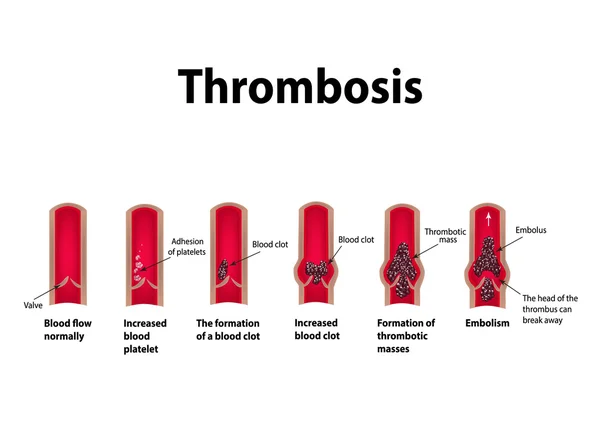 Trombocitosi. Embolia. Infografica. Illustrazione vettoriale su sfondo isolato — Vettoriale Stock