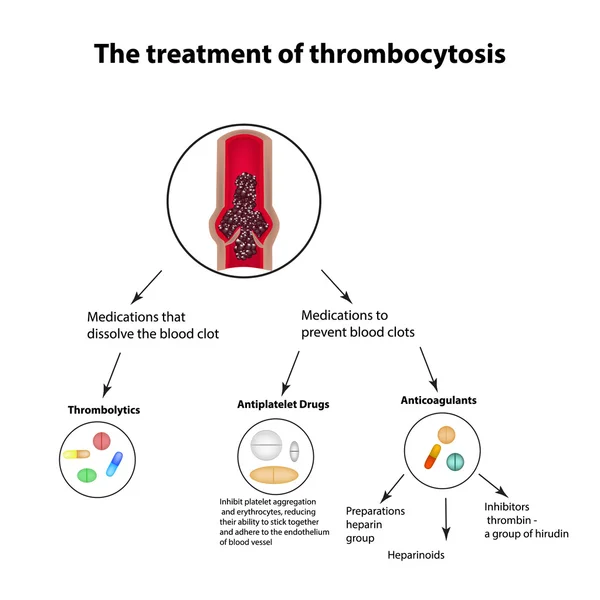 Thrombocytosis의 치료입니다. 색 전 증입니다. 인포 그래픽입니다. 격리 된 배경에서 벡터 일러스트 레이 션 — 스톡 벡터