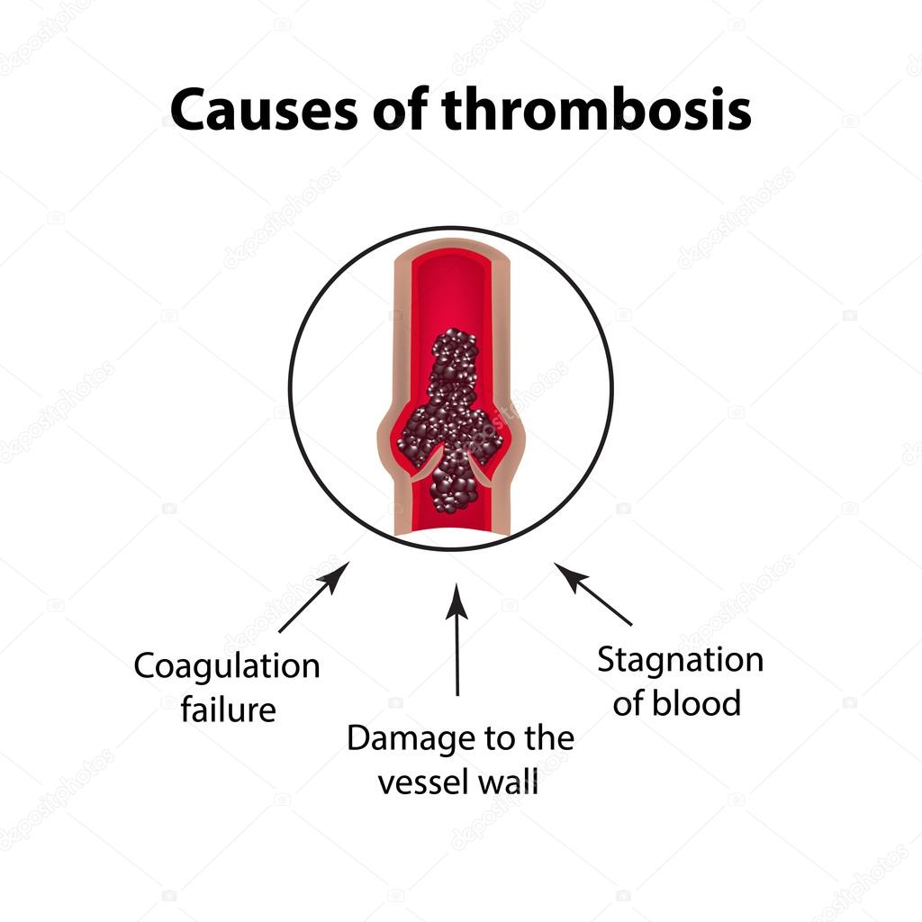Causes of thrombocytosis. Embolism. Infographics. Vector illustration on isolated background