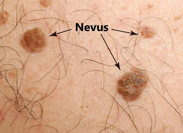 Коричневое пятно на коже. Пигментные пятна и родинки. Крот и волосы на коже. — стоковое фото