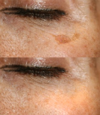 Brown spot on the skin of the face. Pigmentation on the skin. After laser removal clipart